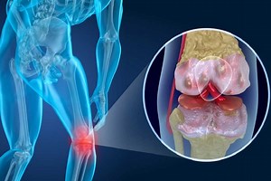 Septic arthritis: symptoms, causes and treatment | Emergency Live