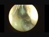 Endoscopic Myringotomy and Grommet Insertion Under Local Anesthesia • Video • MEDtube.net