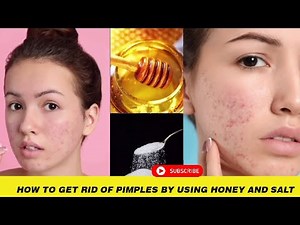 How To Get Rid Of Pimples By Using Honey And Salt