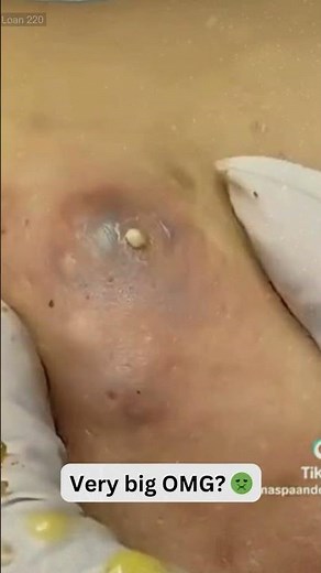 Deep Blackheads, Milia & Whitehead Removal pimple popping New| Big Cystic Acne Extraction #1172 2026