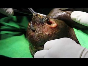 FOURNIER'S GANGRENE DEBRIDEMENT