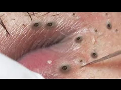 How To Removal Blackhead On lip, Blackhead Acne Treatment#24