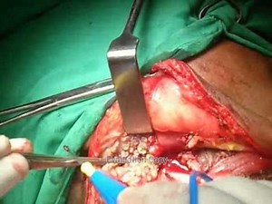 MODIFIED RADICAL NECK DISSECTION BY DR GUNJAN AGRAWAL