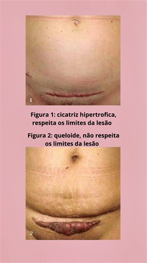Queloide x cicatrização hipertrófica, você sabe a diferença?