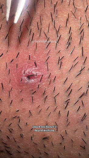 Massive Ingrown Hair Plucking | Satisfying Beard Extraction Video