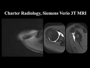 MRI Arthrogram of the Shoulder