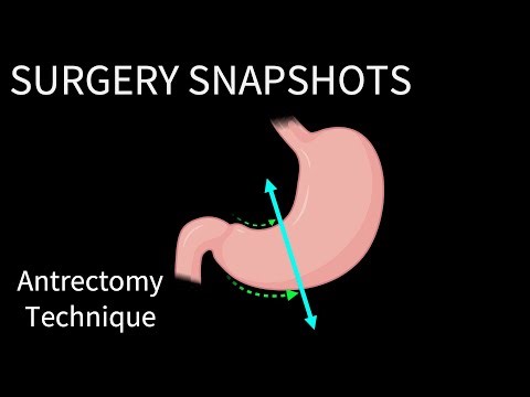 How to Perform the Antrectomy for a Classic-Style Whipple Procedure