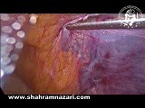 Spermatic Cord Lipomas • Video • MEDtube.net