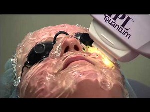 IPL Skin Rejuvenation by Jeffrey Klein MD Dermatology and Associates