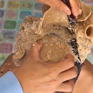 Itchy Dry Scalp Dandruff Removal Satisfying Maggot Worms Biggest Hole​ #1477 Part 11 | Help remove ticks