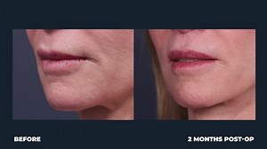 Lip Lift w/ CO2 Laser Resurfacing
