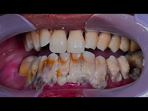 The Giant Tartar Removal Method That Brings Instant Relief #025
