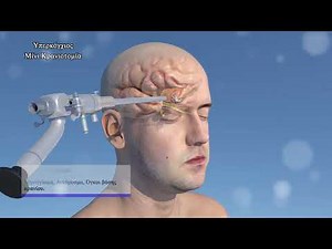 3D Medical animation - Minimally Invasive Neurosurgery