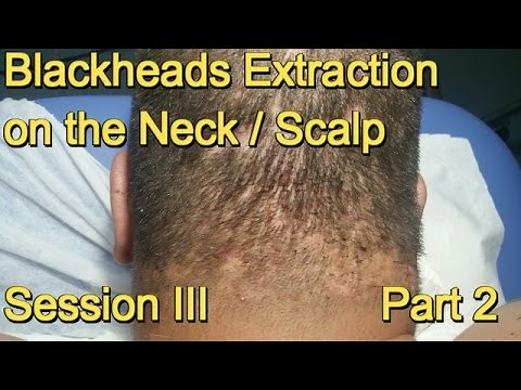 Blackheads Extraction on the Neck / Scalp - Session III . Part 2
