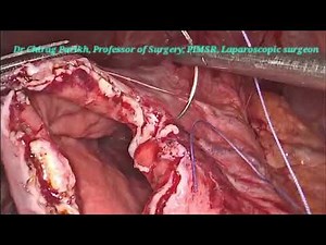 laparoscopic Cystogastrostomy using endostapler in 60 yr female for chronic pseudocyst