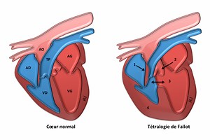 Tétralogie de Fallot: une malformation réparée chirurgicalement