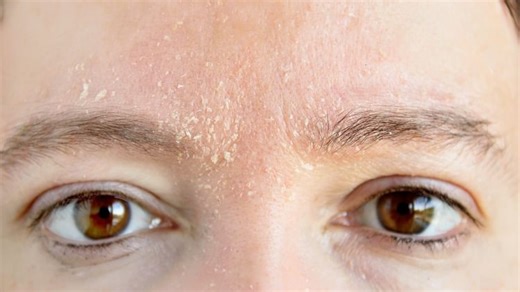 Eyebrow Dandruff Remedy: आईब्रो पर जम रहा है डैंड्रफ तो क्या करें ? ये नुस्खे आएंगे काम