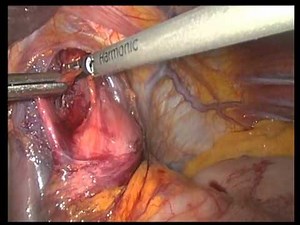Laparoscopic Truncal Vagotomy