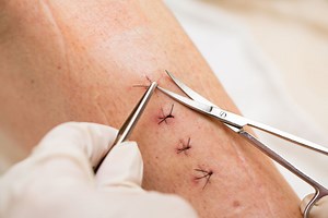 Incision Opening After Surgery: When It Is an Emergency
