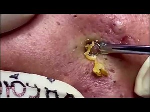 #031 BIGGEST PIMPLE POPPING EVER – INSANE BLACKHEAD REMOVAL & DEEP PORE CLEANING YOU CAN’T MISS!