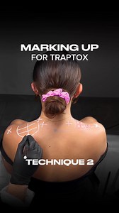 Two ways to mark up for Traptox🩶✔️ By injecting Botox into the trapezius muscles, we slim down the neck and shoulders, creating a more elongated, feminine silhouette. It’s perfect for clients looking to relieve tension while enhancing their posture and overall look 🩶 Thinking about offering TrapTox to your clients? Find the full lesson on my subscription🫶🏼 #botox #botoxnatural #antiwinkle #botoxchallenge #traptox #barbietox | Natalie Page Aesthetics