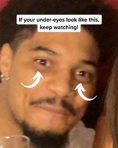 212K views · 49 reactions | Acne scars, dark eyebags, wrinkles, the...