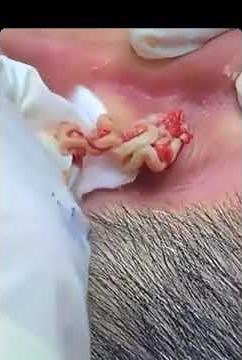 Behind the Ear Cyst