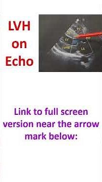 Left ventricular hypertrophy on echo