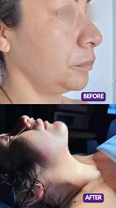 CHIN LIPO 🔥 (Jaw contouring) ✅ Outpatient procedure✅ Board Certified Plastic Surgeon ✅ Fully equipped Hospital❗️Please send us a private message or email to:📩 balticsurgery@gmail.com for more details.••••#BalticSurgery #BalticTijuana #ChinLipo #LipoPapada #JawContouring #ChinLipoTijuana | Baltic Surgery Tijuana - Bariatrics & Plastics