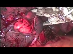 M - Video-assisted thoracoscopic lobectomy - operative technique