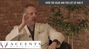 Have acne scarring? In the hands of Dr. B, Bellafill may be the solution! #acne #acnescarring #bellafiill #collagen #filler #drb #accentsmedicalspa | Accents Cosmetic Surgery and Medical Spa