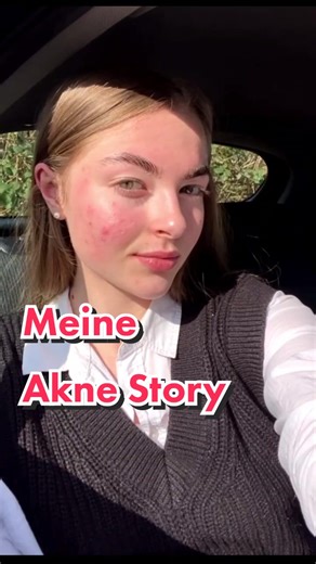 Die Bedeutung von Haut und Selbstwert: Meine Akne Story | Eucerin