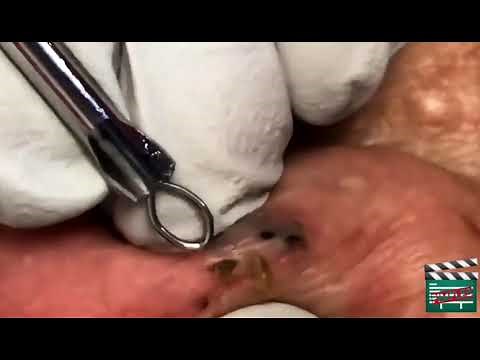 25 Pimple Popping biggest and deepest blackhead behind ear