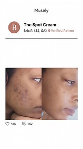 Real patients, real results! Transform your skin with The Spot Cream ✨ Formulated by dermatologists with hydroquinone, it fades dark spots, sun damage, acne scars, and hyperpigmentation. Join over 1 million patients achieving real, lasting results with prescription treatments at Musely.com! | Musely
