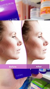 3 comments | Differin-Resurfacing Scar Gel • ព្យាបាលស្នាមខូង ឬ រន្ធញើសធំ | Vst Cambodia | Facebook