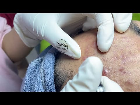 Severe Acne Treatment for Woman | Deep Inflammatory Pimple Extraction at Spa Linh Mun