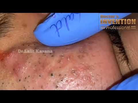 BLACKHEADS REMOVAL BY DR LALIT KASANA
