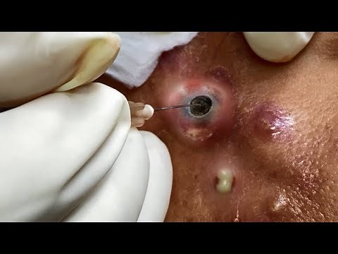 Big Cystic Acne Blackheads Extraction Blackheads 2022 #1
