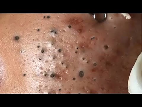 Deep BLACKHEAD Removal on Cheeks - Blackheads, Whiteheads, Pus Removal on Face