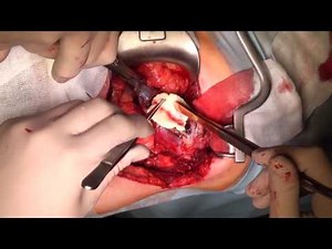 Partial nephrectomy (open - 3 cases)/ Открытая резекция почки (3 операции)