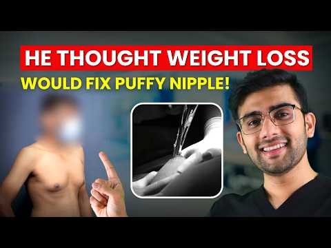 Puffy Nipples Before And After Surgery | Real Patient Transformation | Dr DC, Plastic Surgeon
