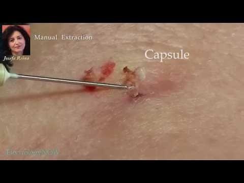 Josefa: Removal of a Sebaceous Cyst (gigantic blackhead)