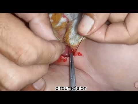 Circumcision by surgical bone cutter & surgical focipes Docter sadiq shah
