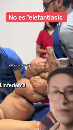 No sé llama elefantiasis, se llama linfedema #saludybienestar #Salud #viralvideo #reelsviralシfb #viralvideoシ | Doc Ale