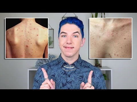 How to Get Rid of Body Acne