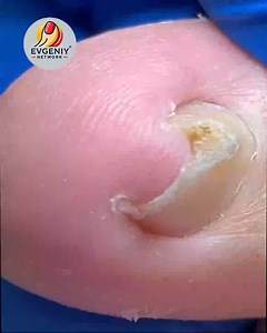 U.S. Foot Doctors Recommend Brittle Toenails Endorsed by U.S. Wellness Clinics#FootCareTips #SimpleHealthTricks #HealthyHabits #NailCareTips | Evgeniy