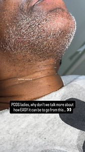 Electrolysis works on ALL hair colors, even stubborn gray ✨ #permanenthairremoval #electrolysis #Atlanta #pcos #reels #laserhairremoval #fyp #esthetics #explorepage #hormonalacne #viralreels #foryou #electrolysisatlanta #electrolysis #hairlesssolution #electrologist #atlelectrolysis #georgia | Hairless Solution Electrolysis