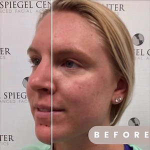 55 reactions · 56 comments | Beautiful tear trough filler results at #thespiegelcenter  #undereyebags #undereyefiller #teartroughfillers #teartrough #aestheticinjector #bostondoctors | The Spiegel Center | Facebook