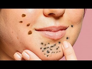 Pimple Popping Tool Kit - Blackhead and Pimple Remover Kit (Professional)