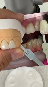 2-Unit Kosmic Press Anterior Crowns, shaded in A1. Case from Dr. William Burghardt in Massachusetts. For longer educational videos, sign up at: patreon.com/lukekahng EnvisionTEC Jensen Dental LuxeSmile | LSK121 Oral Prosthetics